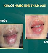 Khử Thâm Môi Nam Có Tốt Không